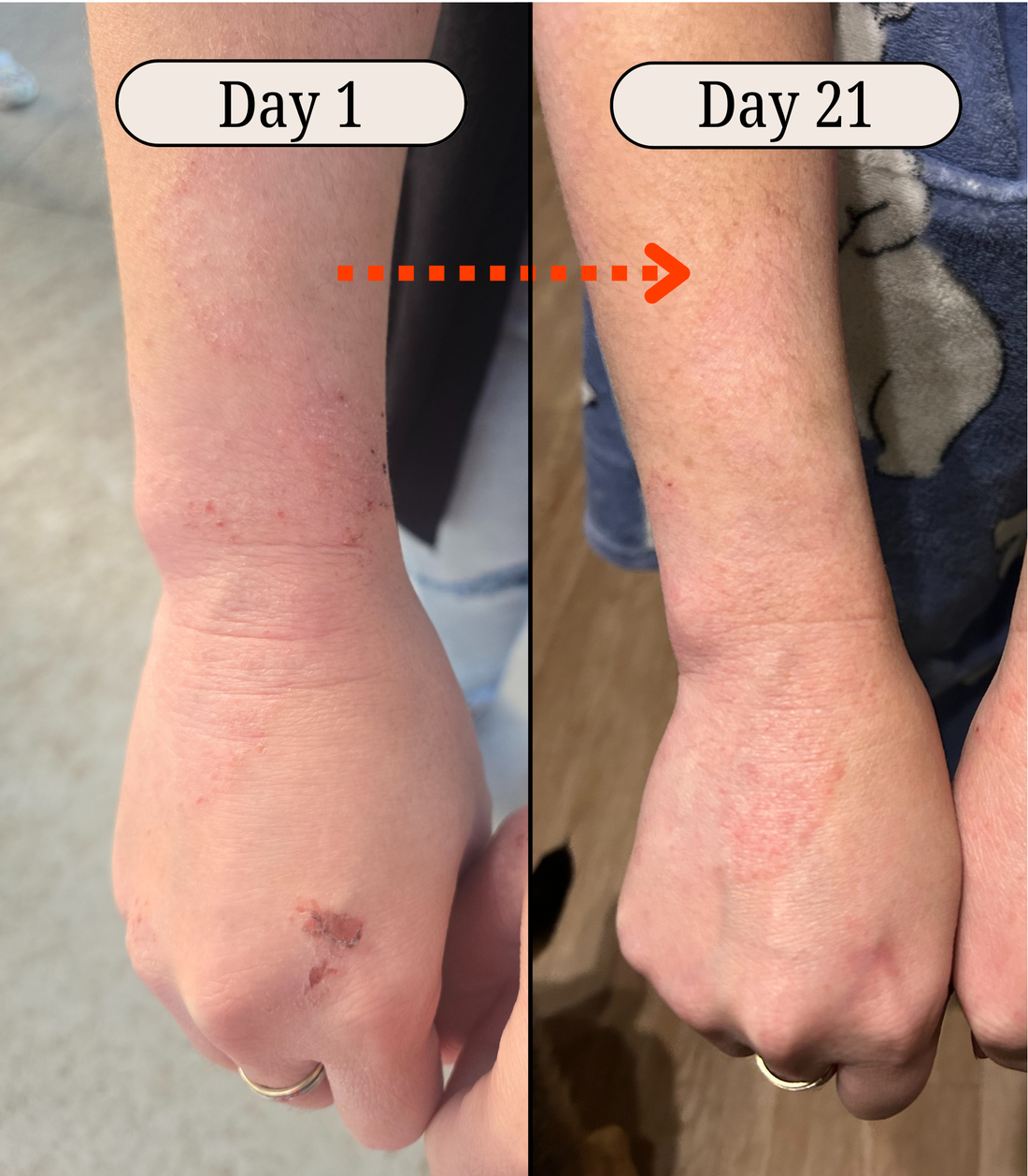 Eczema Trial Week Three