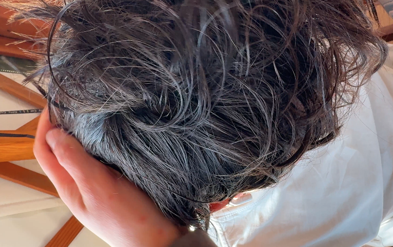 How I got rid of my dandruff