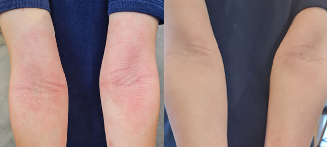 Eczema Trial Week One