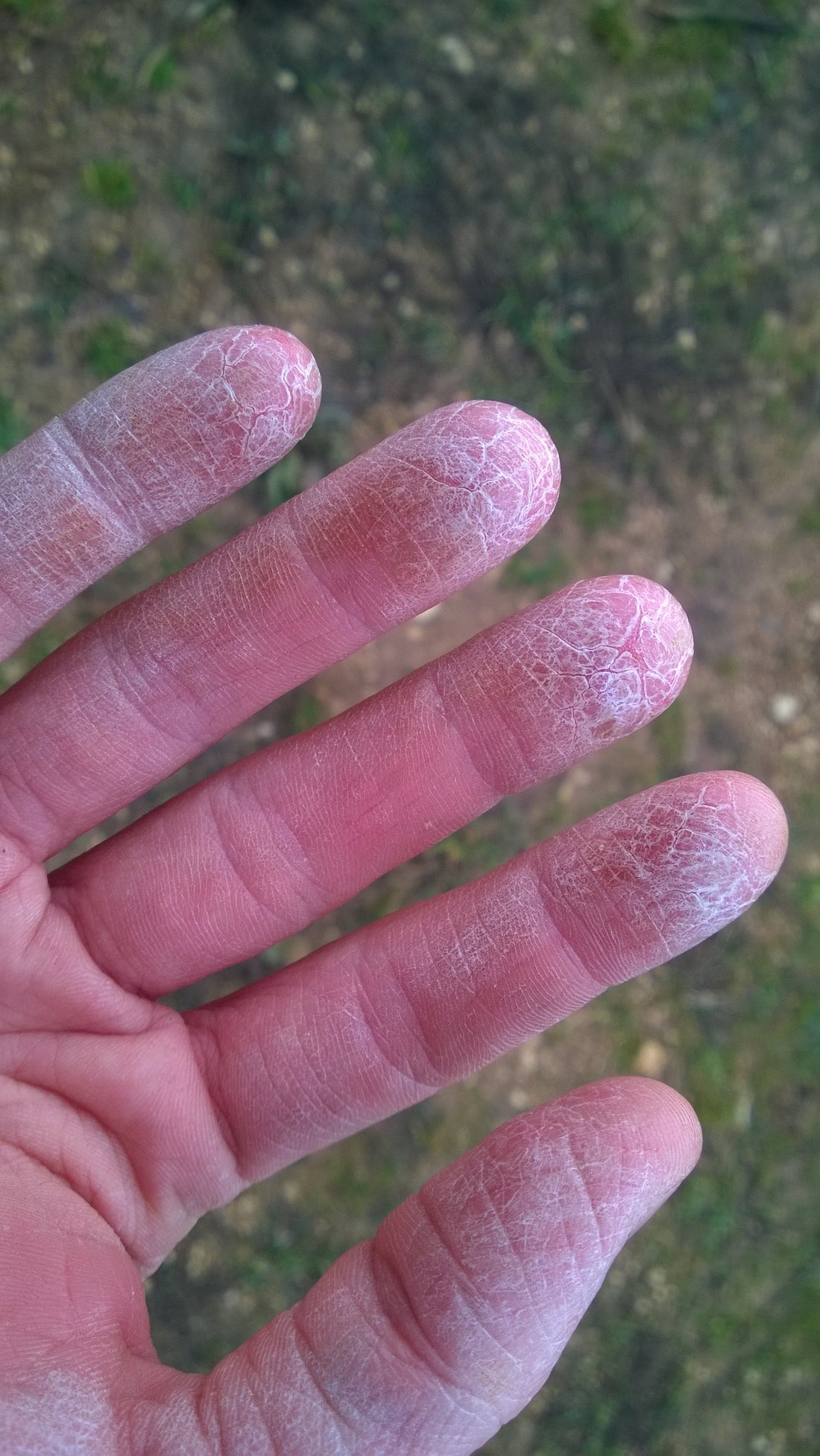 My eczema journey, and Mānuka oil