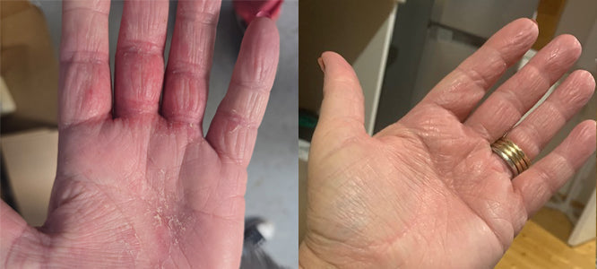 Eczema Trial Week Two