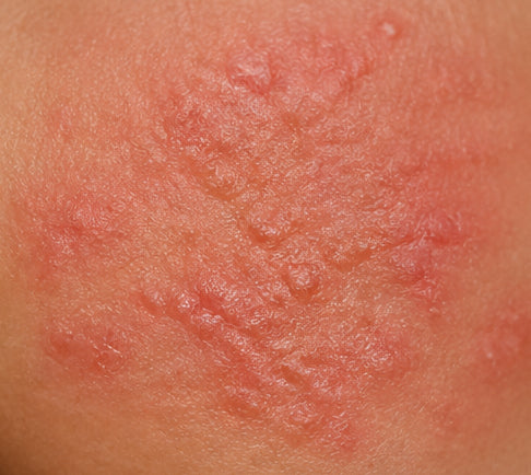 Eczema
