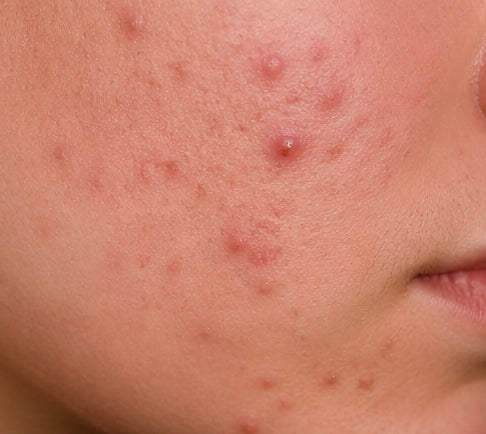 Acne